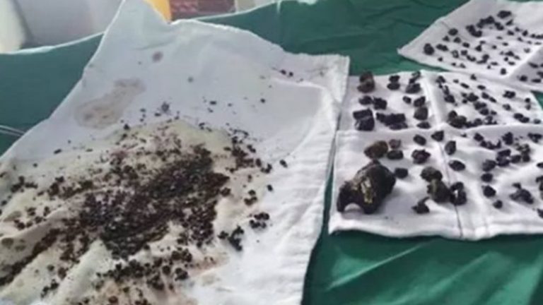 Mjekët ia largojnë mbi 200 gurë nga trupi, tregojnë arsyen e formimit të tyre (Foto, +16)