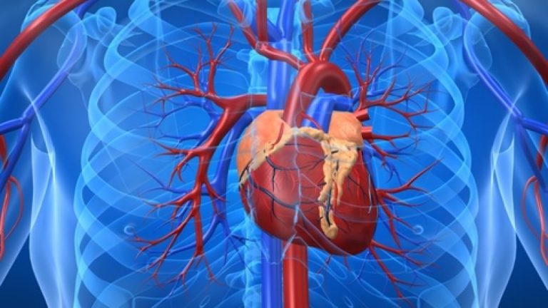 Kalciumi në arterie mund të jetë parashikuesi më i mirë i sulmit në zemër apo në tru