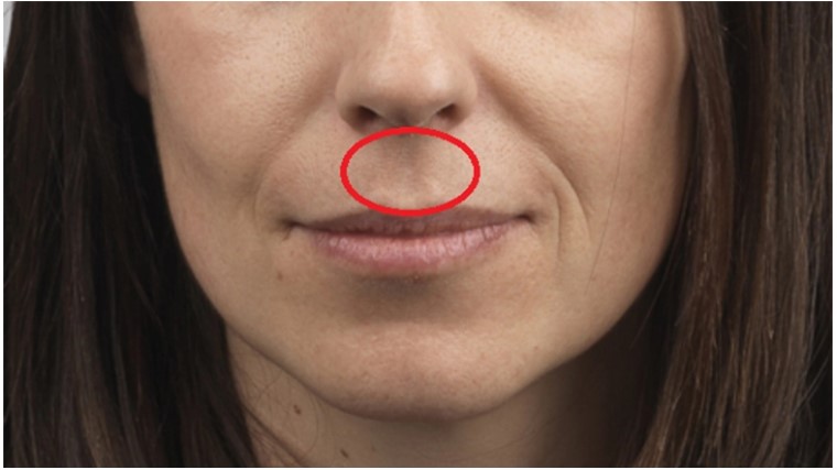Keni këtë gropë midis hundës dhe buzës së sipërme? Do të çuditeni kur të lexoni çfarë do të thotë kjo