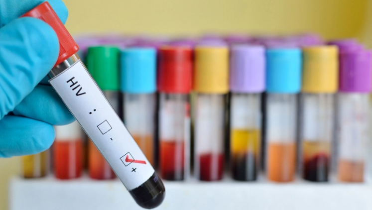 HIV: Simptomat, transmetimi, mbrojtja dhe trajtimi