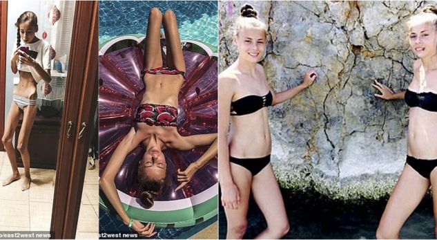 Shkolla e modelimit u kërkoi të ishin më të dobëta, binjaket 14-vjeçare bëhen kockë e lëkurë nga anoreksia