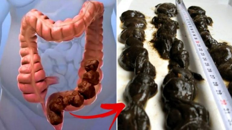 Në zorrë kemi deri 15 kg helme që shkaktojnë sëmundjet më të rënda: Ekspertët zbulojnë se si t’i nxjerrim nga trupi!