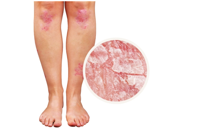 Q10, vitamina E dhe seleni kundër psoriazës