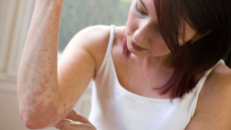 Problemet psikike dhe psoriaza: Çfarë do të thotë kur sëmundja shfaqet në kokë dhe çfarë të bëni kur e keni në dorë?