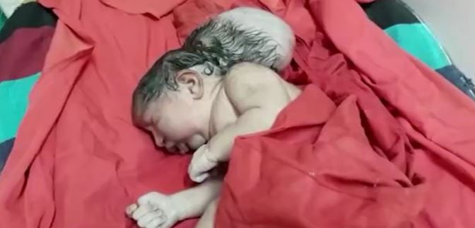 E rrallë: Lind një bebe me tri koka