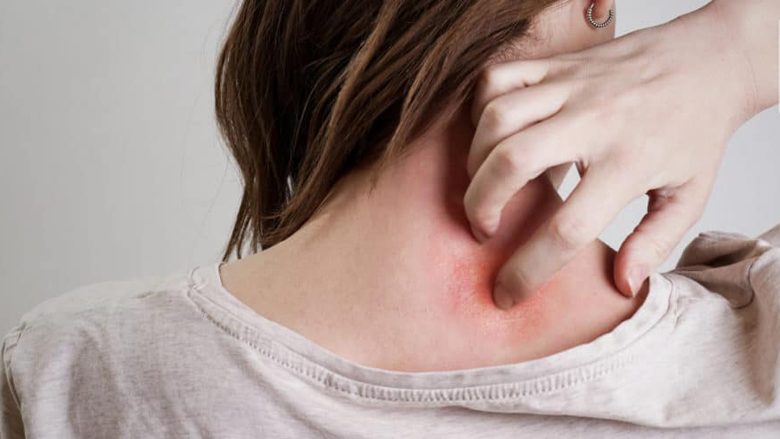 Lufta kundër psoriazës: Kindla qetëson simptomat