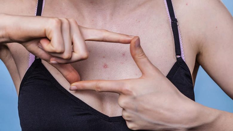 Tetë mënyra për eliminimin e akneve të këqija dhe të dhembshme nga gjoksi – dhe do të mësoni se çfarë i shkakton
