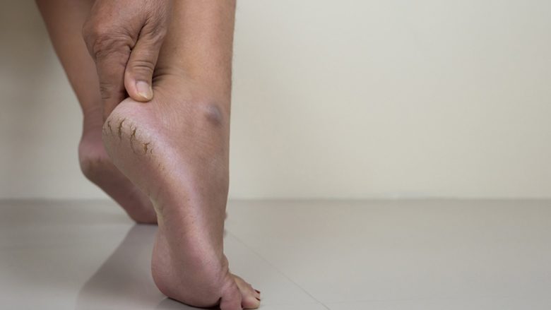 Zgjidhini problemin me thembrat e plasaritura me një përbërës nga kuzhina