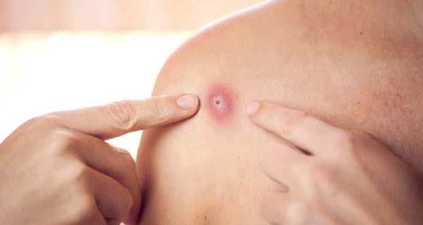 Lija e majmunëve, çfarë duhet të dimë për virusin që po përhapet në Evropë