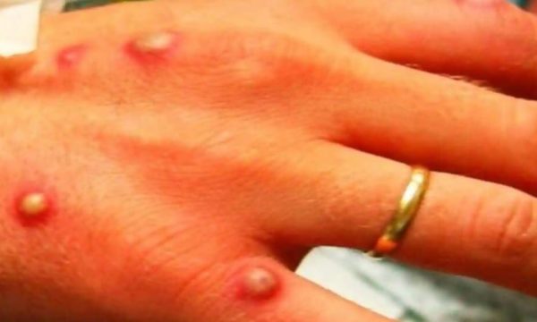 Lia e majmunëve, OBSH: Bota po përballet me sfida të frikshme