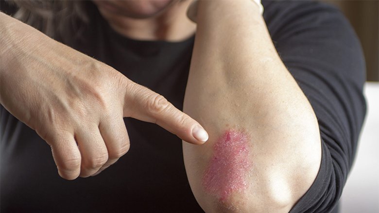Psoriaza e lidhur me diabetin dhe hipertensionin