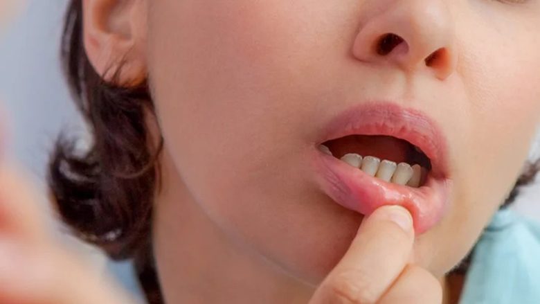 Keni pasur gjithmonë buzë të çara? Urgjentisht duhet ta bëni analizën e gjakut!