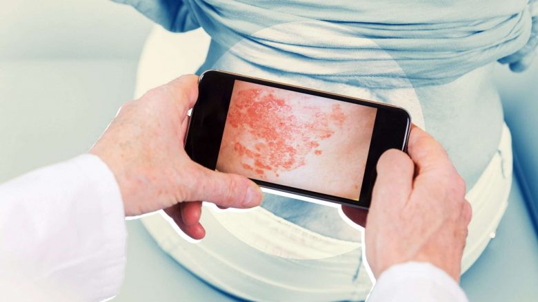 Psoriaza reagon ndaj motit të ftohtë, si të shmanget përkeqësimi i sëmundjes